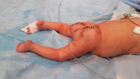 Novorozenec po operaci.