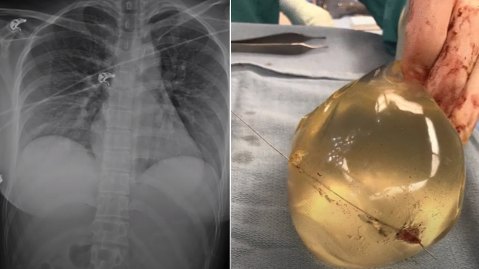 Byla postřelena. Silikonová prsa jí zachránila život